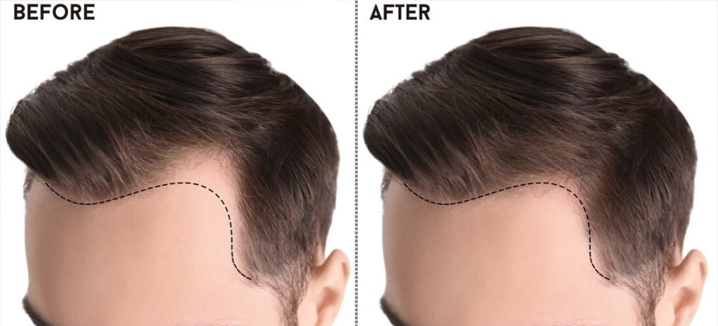 before and after hair transplant